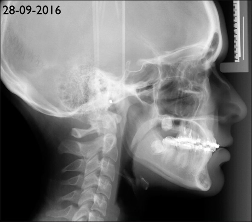 Open Bite Treated with Extractions and Temporary Anchorage Devices ...