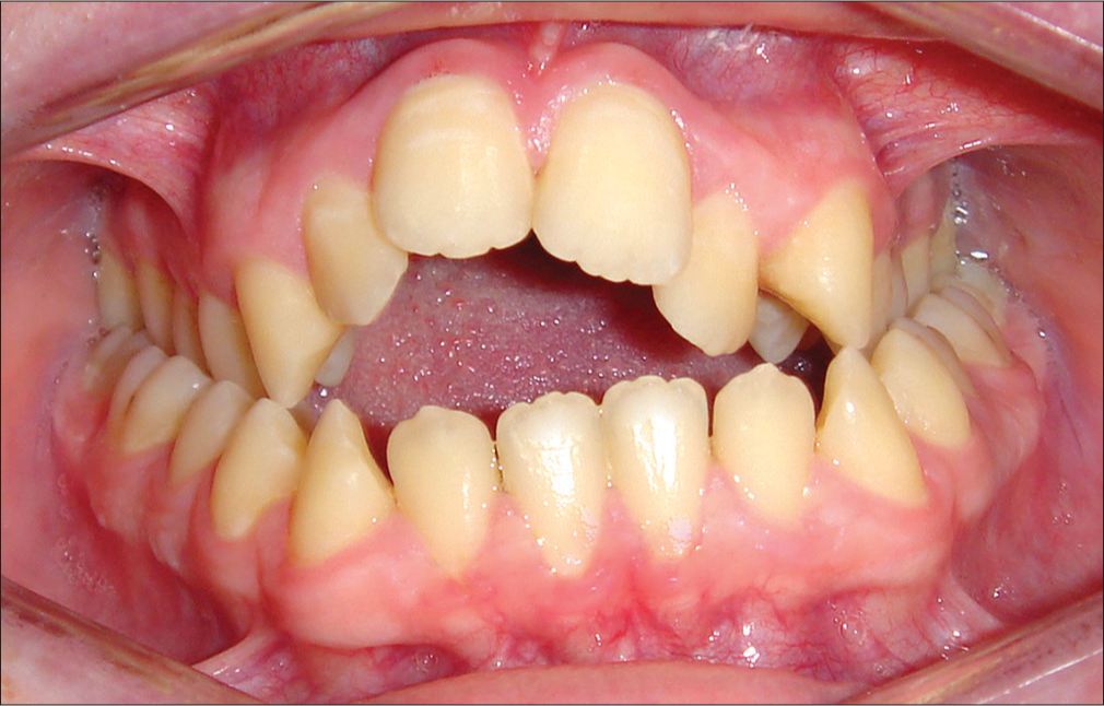 Asymmetrical anterior open bite in a patient aged 17 years with a continued thumb sucking habit. Narrowing of the maxillary arch is common in such cases