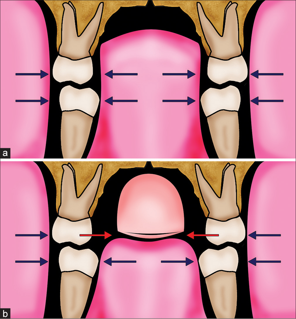 (a) Schematic representation of the average patient, with the teeth in a zone of soft-tissue equilibrium between the pressure from the soft-tissue forces of the cheeks and tongue. (b) In a patient with a prolonged digit-sucking habit, the digit (e.g., thumb) displaces the tongue inferiorly. The excessive buccal forces from the cheek musculature due to forces generated by sucking pressure will be offset by those from the highly muscular tongue situated between the mandibular dentition but lead to narrowing of the maxillary dentition where they are unopposed. (From: Naini FB, Gill DS, editors. Orthognathic Surgery: Principles, Planning and Practice. Oxford: Wiley-Blackwell; 2017; used with permission)