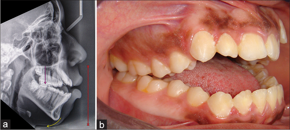 (a and b) Skeletal anterior open bite due to increased lower anterior face height. The mandibular ramus height is average. There is posterior VME, which has led to a posterior rotation of the mandible, moving the chin downward, and backward relative to the face. There is an adaptive forward position of the tongue. (From: Naini FB, Gill DS, editors. Orthognathic Surgery: Principles, Planning, and Practice. Oxford: Wiley-Blackwell; 2017; used with permission)