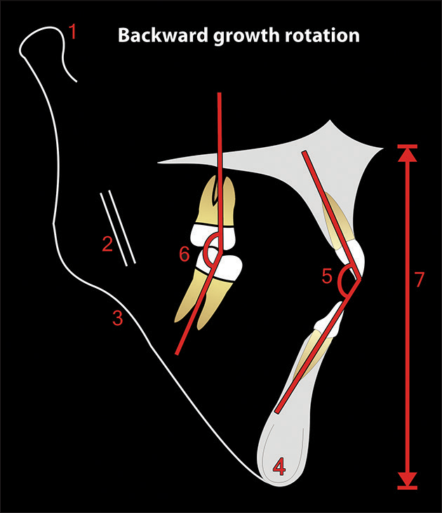 Björk’s seven structural signs, which may be used to indicate the pattern of posterior (backward) mandibular growth rotation [Explanation of the numbers - Table 2]. (From: Naini FB, Gill DS, editors. Orthognathic Surgery: Principles, Planning and Practice. Oxford: Wiley-Blackwell; 2017; used with permission)