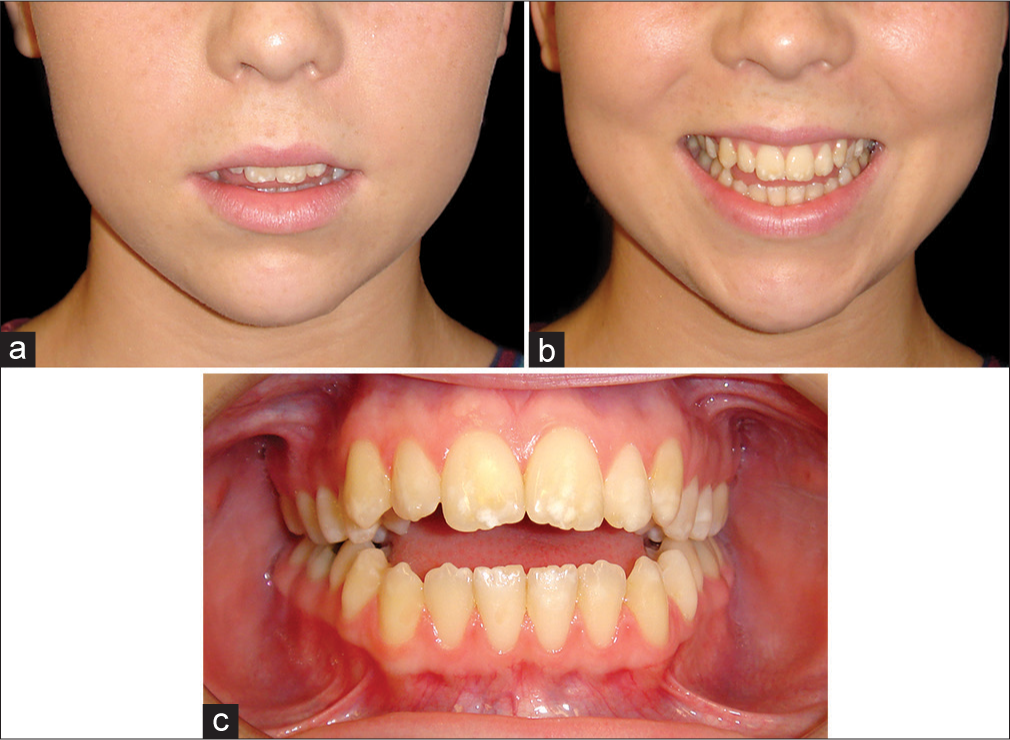 (a and b) Example of a skeletal anterior open bite with adaptive tongue posture, with good lip-incisor relationship at rest and smiling. Therefore, the problem is entirely posterior vertical maxillary excess and posterior mandibular rotation. Lower anterior face height is slightly increased, and there is a mild incomplete lip seal. Preparatory orthodontic treatment should aim to maintain the lip-incisor relationship, and impact the posterior maxilla