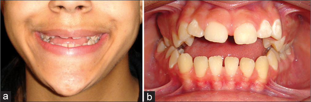 (a and b) Example of an anterior open bite with a significant soft tissue (tongue) etiology. Maxillary incisor exposure is reduced at rest and on smiling. An important treatment aim should be to increase the maxillary incisor exposure