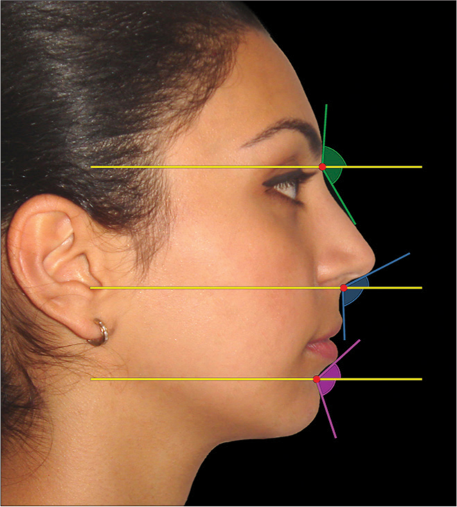 Angular profile parameters may be visually separated into upper and lower components and a qualitative decision made as to whether they are obtuse, average, or acute. The patient should be in natural head position. The nasofrontal, nasolabial, and mentolabial angles are demonstrated separated into the upper and lower components by a true horizontal line. The nasolabial angle has an upper (columellar) component and a lower (upper lip) component. These two components may vary independently. (From: Naini FB, Gill DS, editors. Orthognathic Surgery: Principles, Planning and Practice. Oxford: Wiley-Blackwell; 2017; used with permission)