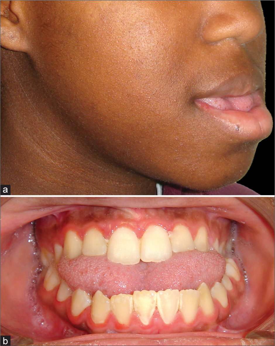 (a and b) Female patient with severe Class III skeletal pattern and anterior open bite, and a large tongue