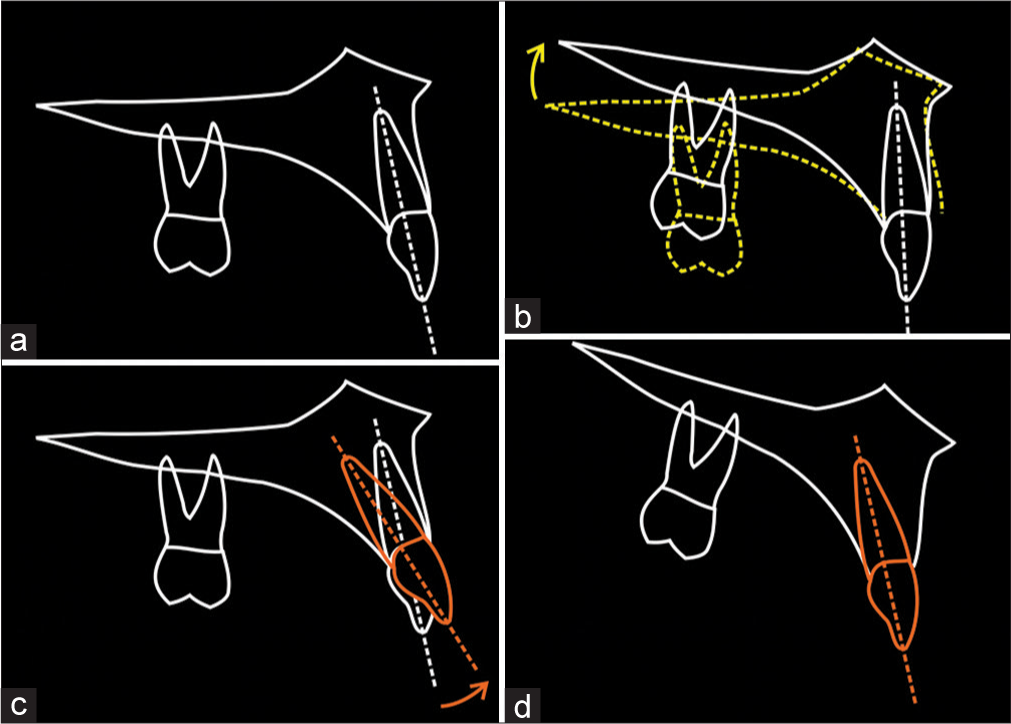 Incisor inclination preparation for differential posterior maxillary impaction. (a) In the preoperative position, with the maxillary incisors at an average inclination. (b) In association with a differential posterior impaction of the maxilla, the maxillary incisors will retrocline. They are now excessively retroclined. (c) Therefore, a compensatory degree of incisor proclination must be built into the preoperative orthodontic preparation. (d) As such, the maxillary incisors will effectively retrocline as the maxilla rotates with the posterior impaction, thereby correcting their inclination with surgery. (From: Naini FB, Gill DS, editors. Orthognathic Surgery: Principles, Planning and Practice. Oxford: Wiley-Blackwell; 2017; used with permission)