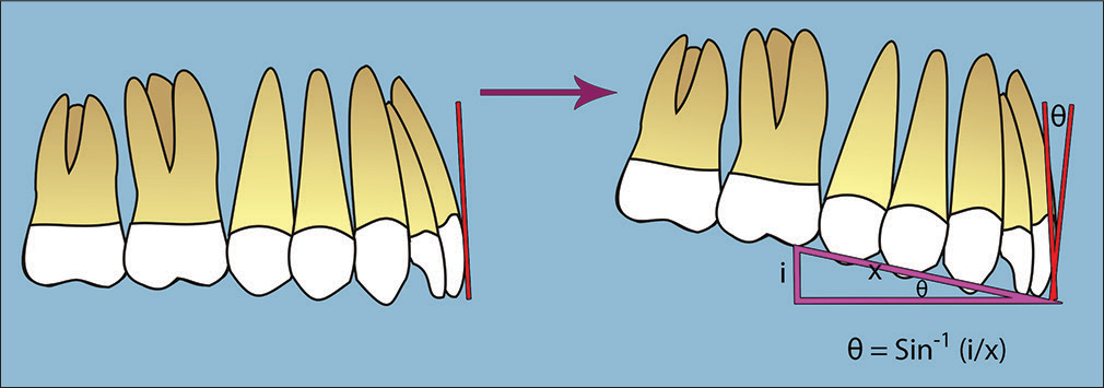 Posterior maxillary impaction has a retroclining effect on the maxillary incisors. The effect is proportional to the amount of impaction (i) and the length of the maxilla (x). A formula has been described to calculate the amount of proclination that should be incorporated during preoperative orthodontic treatment.[23]. (From: Naini FB, Gill DS, editors. Orthognathic Surgery: Principles, Planning and Practice. Oxford: Wiley-Blackwell; 2017; used with permission)