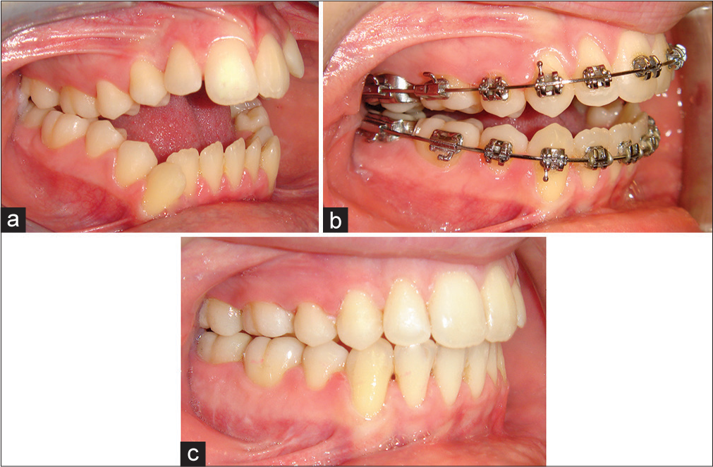 Example demonstrating preoperative leveling (flattening) of the maxillary and mandibular dental arches. (a) Pretreatment view (b) Preoperative view (c) End of treatment view