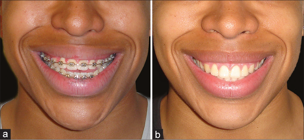 (a) Preoperative view, demonstrating a flat smile curvature (smile arc) relationship. (b) Following differential posterior impaction of the maxilla and the increase in the maxillary occlusal plane inclination, there is an improved smile arc relationship. (From: Naini FB, Gill DS, editors. Orthognathic Surgery: Principles, Planning and Practice. Oxford: Wiley-Blackwell; 2017; used with permission)