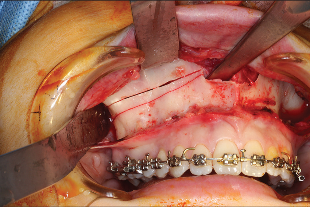 The osteotomies are made such that removal of a tapering bone strip of appropriate width, greater posteriorly than anteriorly, will result in differential posterior impaction of the maxilla
