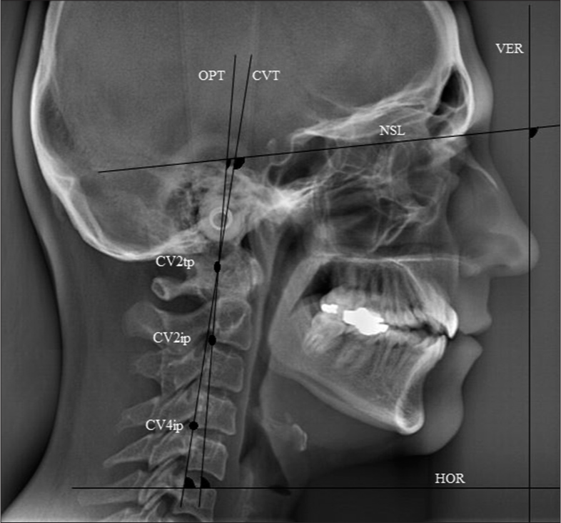 Cephalometric measurements traced on the lateral cephalometric radiographs in natural head position