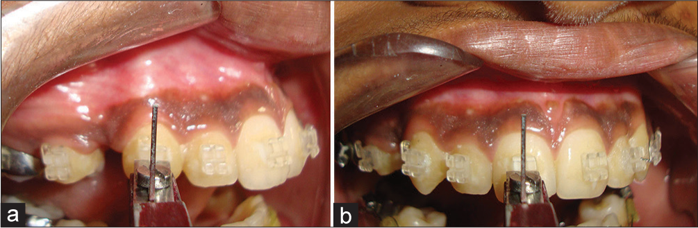 Assessing the horizontal positioning of brackets using the modified bracket gauge on canine tooth (a). Assessing the horizontal positioning of brackets using the modified bracket gauge on incisors (b)