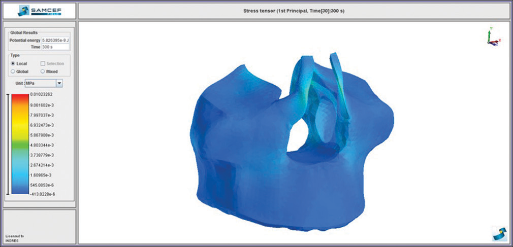 Von Mises stress distribution on the maxilla