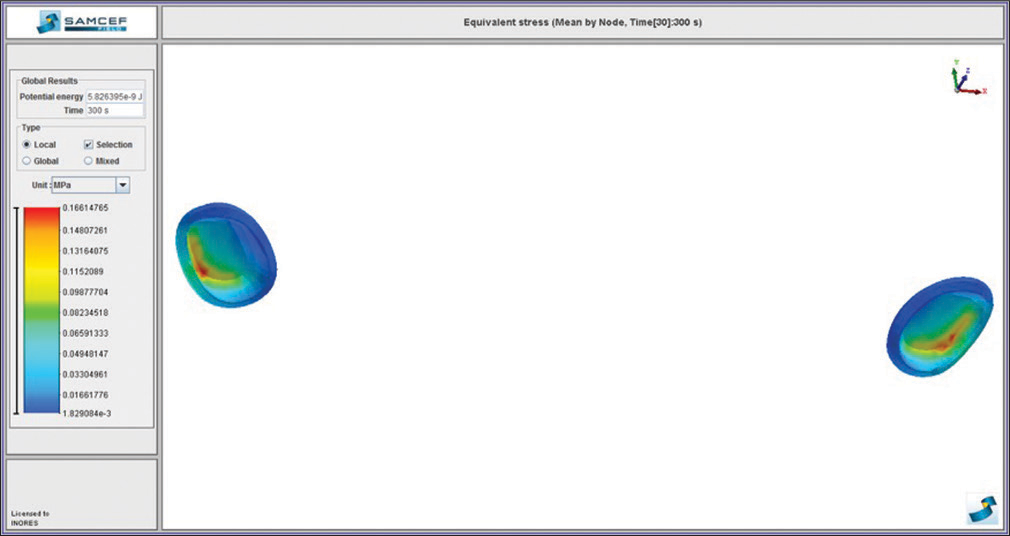 Von Mises stress distribution on the temporomandibular joint discs