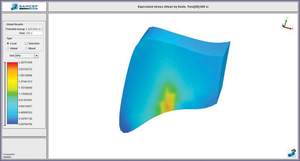 Von Mises stress distribution on the frontomaxillary suture