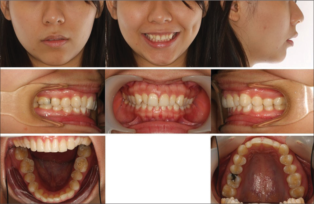 Pretreatment extra- and intra-oral photographs