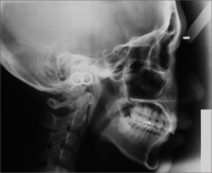 Pretreatment lateral cephalogram