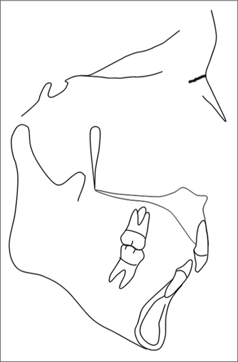 Tracing of pretreatment lateral cephalogram