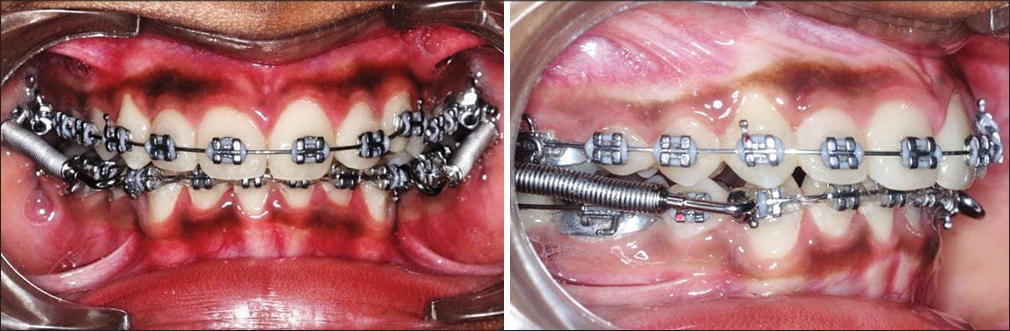 After space closure forsus fatigue resistance device (29 mm size) was placed