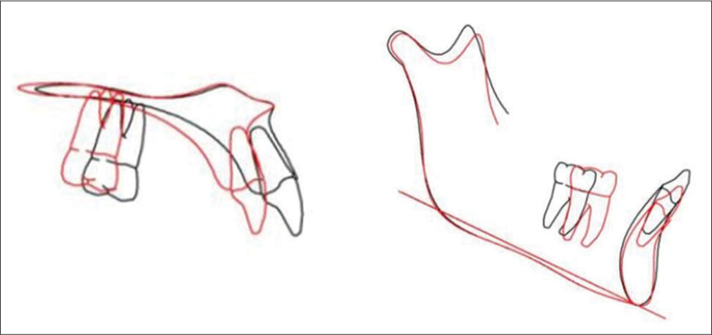 Posttreatment superimposition of maxilla and mandible