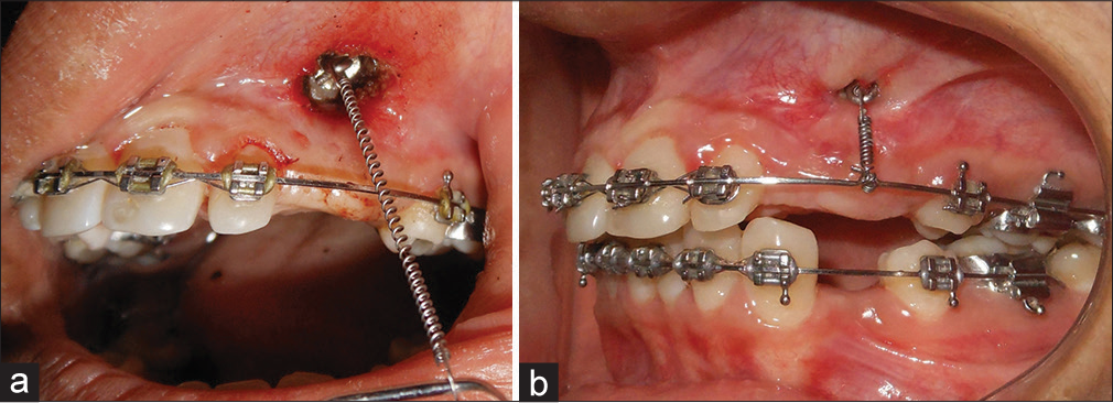 (a) Modified spring for vertical eruption of canine. (b) Progress