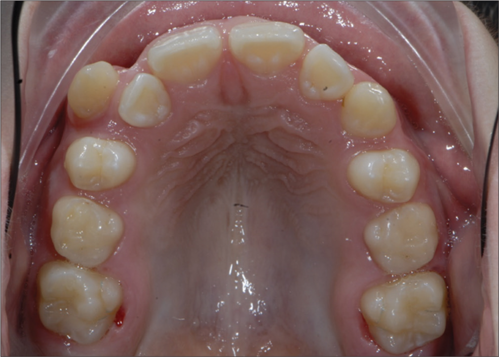 Before insertion of the trans palatal arch