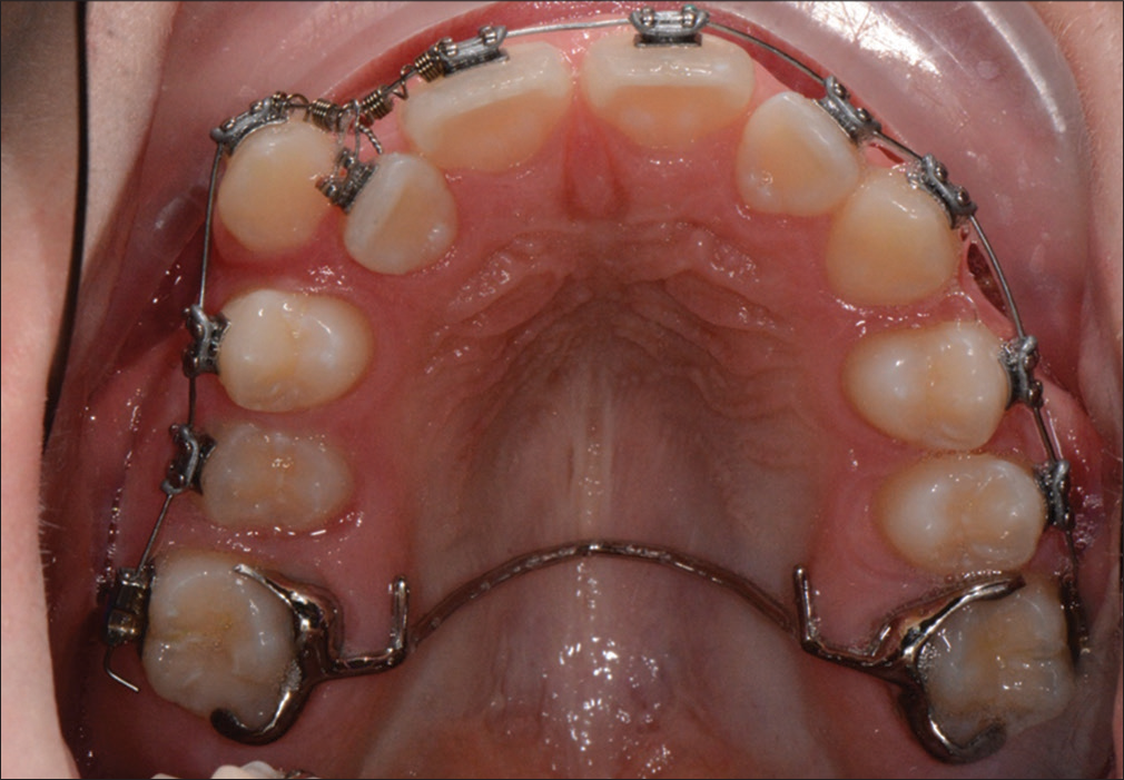 Begin of active treatment with fixed multibracket appliance