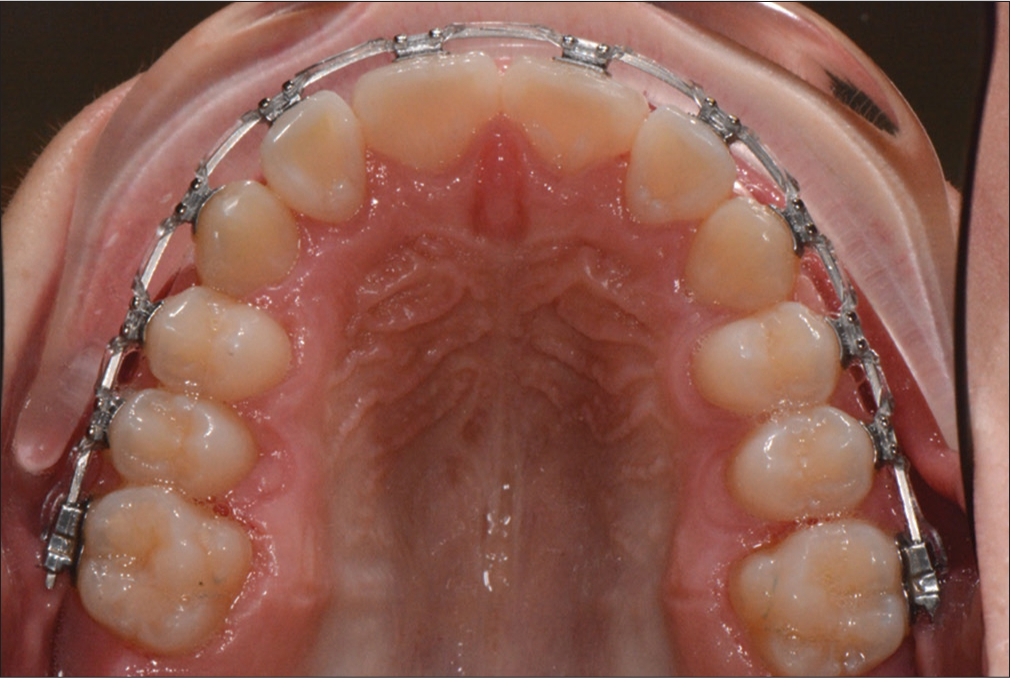 After removal of the trans palatal arch