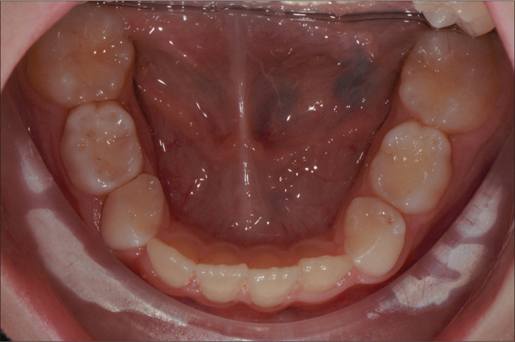 Before insertion of the active lingual arch