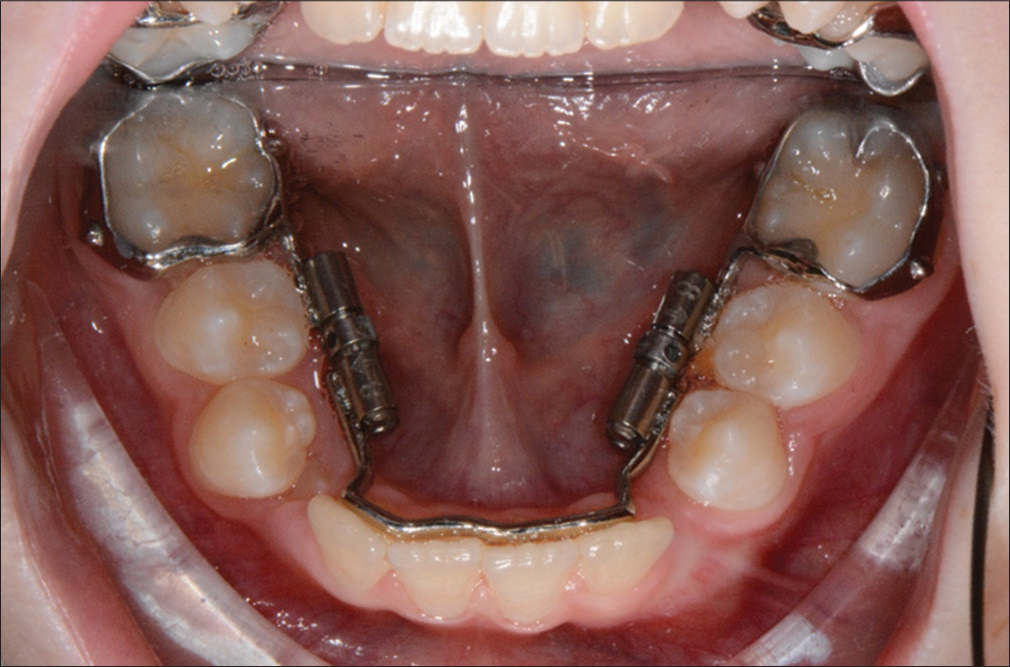 Activation phase, eruption of permanent teeth