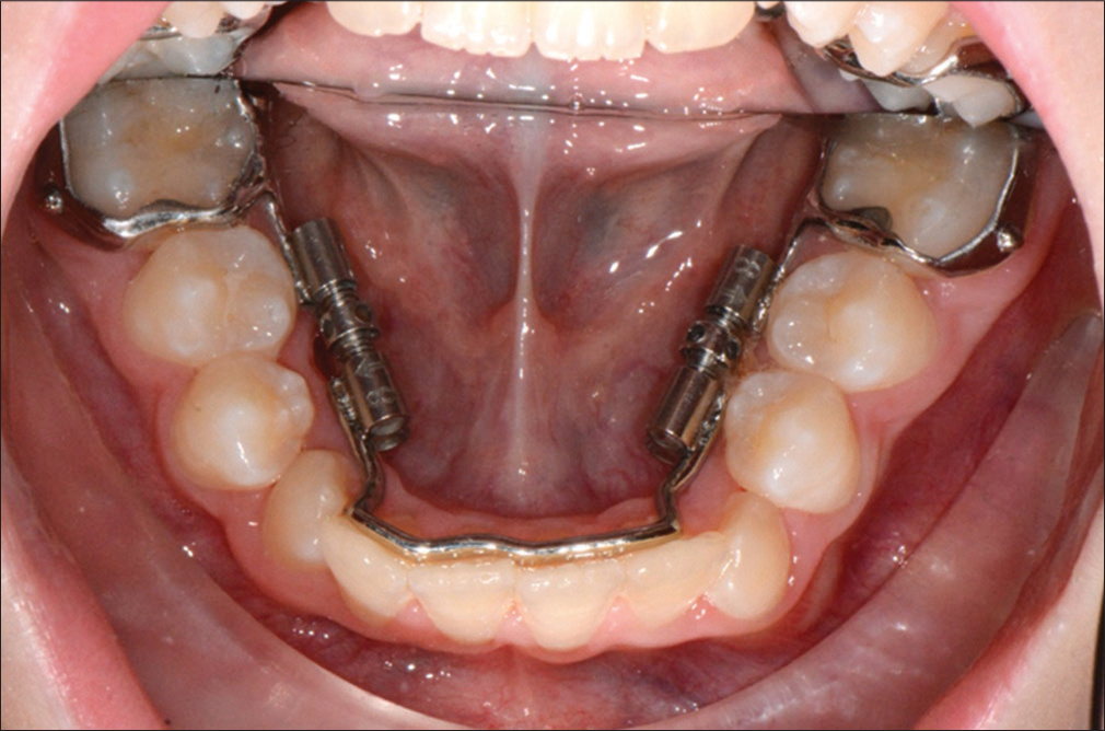 End of activation and tooth change