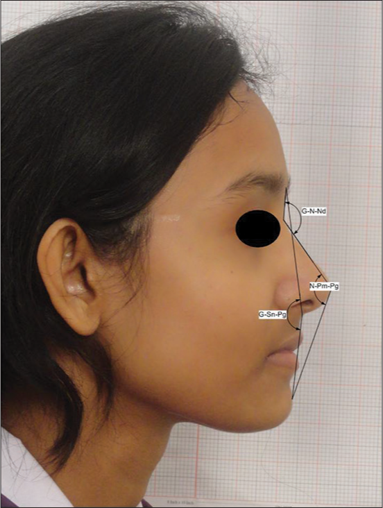 Angular parameters of the nasofrontal angle (G – N – Nd); total facial angle or facial convexity including the nose (N – Prn – Pg); facialangle or angle of facial convexity excluding the nose (G – Sn – Pg)