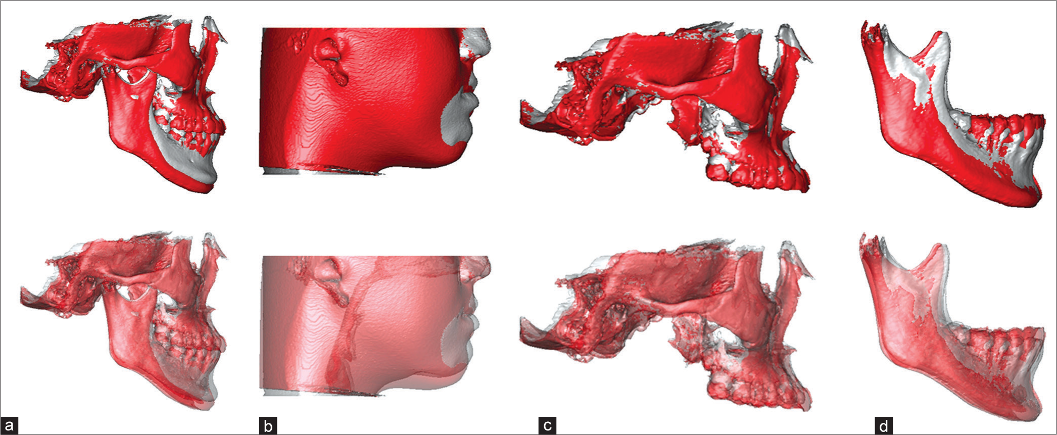 The three-dimensional superimpositions of the pretreatment (silver-gray color) and posttreatment (red color) cone-beam computer tomography images of the Technique-1 case report in Figure 1. (a) The overall skeletal superimposition on cranial base revealed the mandible was clockwise rotated 2.9°, downward 5.5 mm, and backward 3.2 mm; (b) The overall soft-tissue superimposition based on overall skeletal superimposition on cranial base revealed the soft-tissue chin project was reduced 3.4 mm; (c) The cranial base superimposition without mandible revealed the maxillary dentition was extruded 2.5-4.3 mm; (d) The mandibular superimposition illustrated the lower dentition was extruded 1.8–5.5 mm, and the mandible grew 3.3 mm
