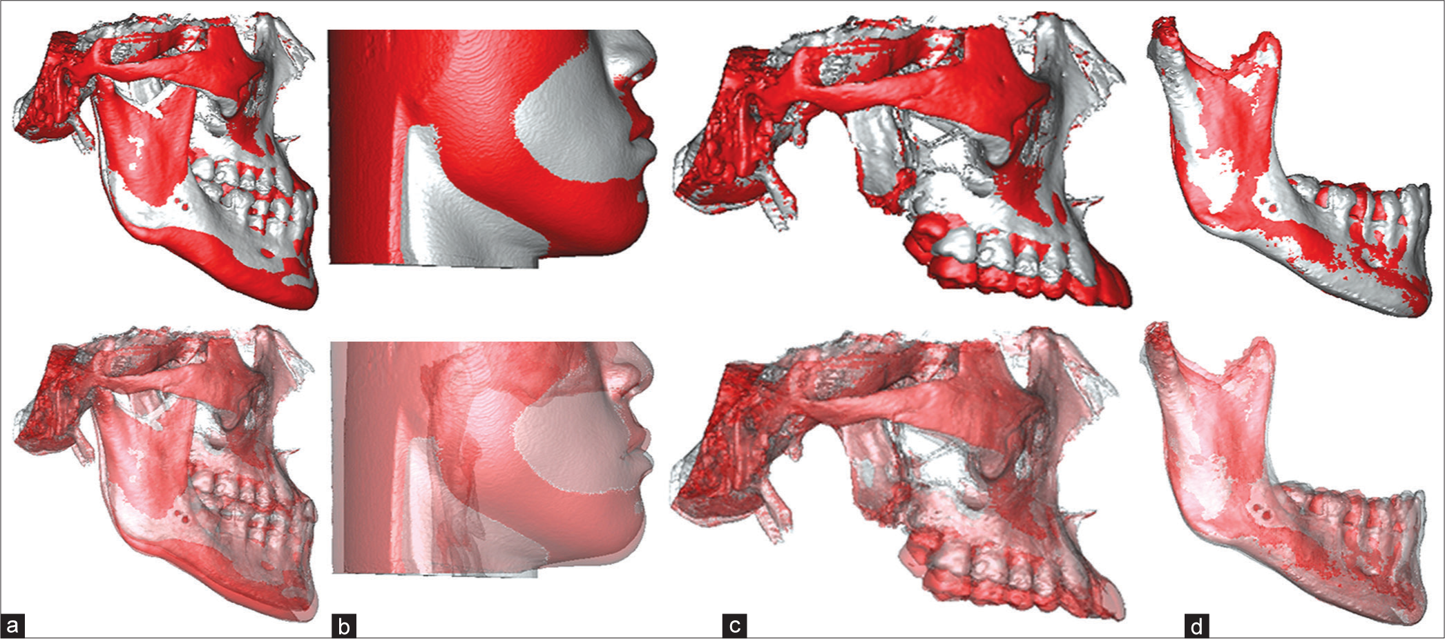 The three-dimensional superimpositions of the pretreatment (silver-gray color) and posttreatment (red color) cone-beam computer tomography images of the Technique-2 case report in Figure 3. (a) The overall skeletal superimposition on cranial base revealed the mandible was clockwise rotated 0.9°, downward 3.7 mm, but forward 1.5 mm; (b) The overall soft-tissue superimposition based on overall skeletal superimposition on cranial base revealed the soft-tissue chin moved downward 4.5 mm but forward 1.3 mm due to inadequate clockwise rotation of mandible, growth of mandible, and no extrusion of lower dentition; (c) The cranial base superimposition without mandible revealed the maxillary dentition was extruded 0.9–6.6 mm; (d) The mandibular superimposition illustrated lower dentition was intruded 1.1–2.7 mm, and the mandibular condyle grew 3.7 mm