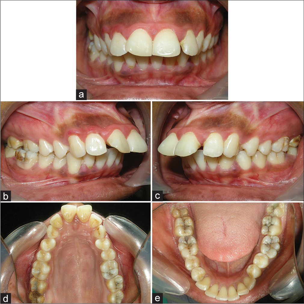 (a-e) Pretreatment intraoral photographs