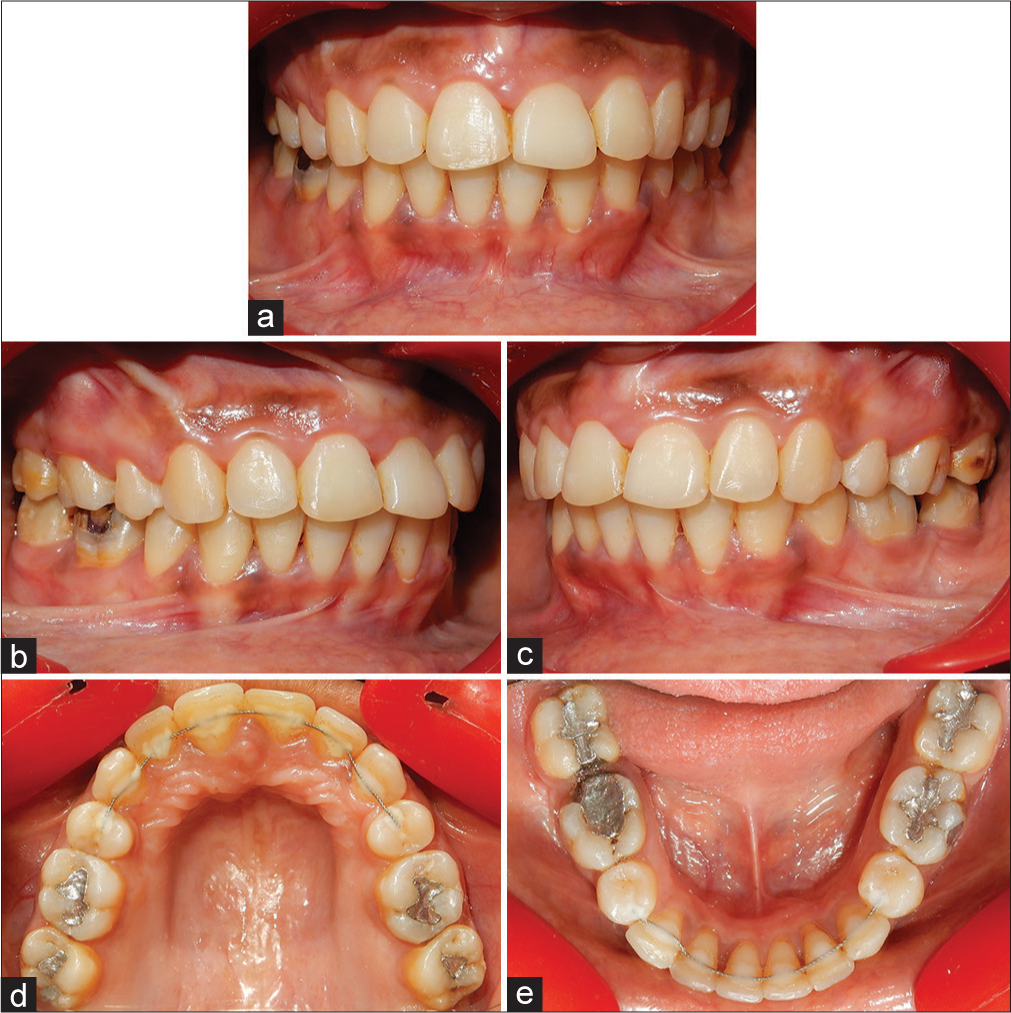 (a-e) Posttreatment intraoral photographs