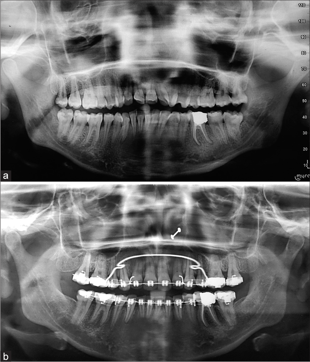 (a) Pretreatment panoramic radiograph. (b) Posttreatment panoramic radiograph