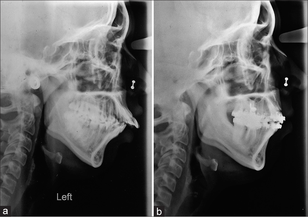 (a) Pretreatment lateral cephalogram. (b) Posttreatment lateral cephalogram