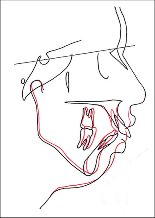 Superimposition of pre- and posttreatment cephalometric tracings, showing upper molar intrusion, autorotation of mandible, and decrease in lower anterior facial height