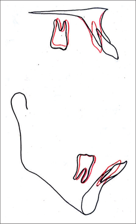 Regional superimposition tracings