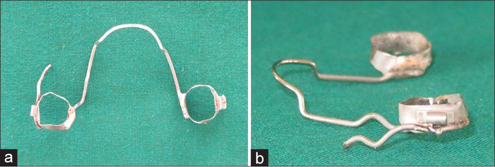 (a and b) Modified lingual arch made of 0.038” SS wire