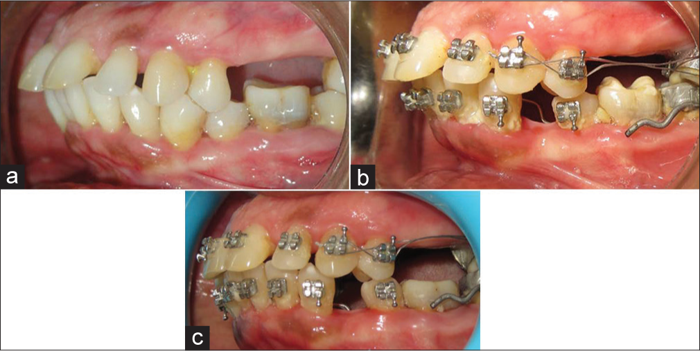 (a) Pretrearment, (b) 2.5 months after placement of modified lingual arch, (c) posttreatment