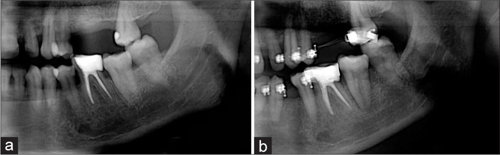 (a and b) Section of pre- and post-treatment orthopantomogram