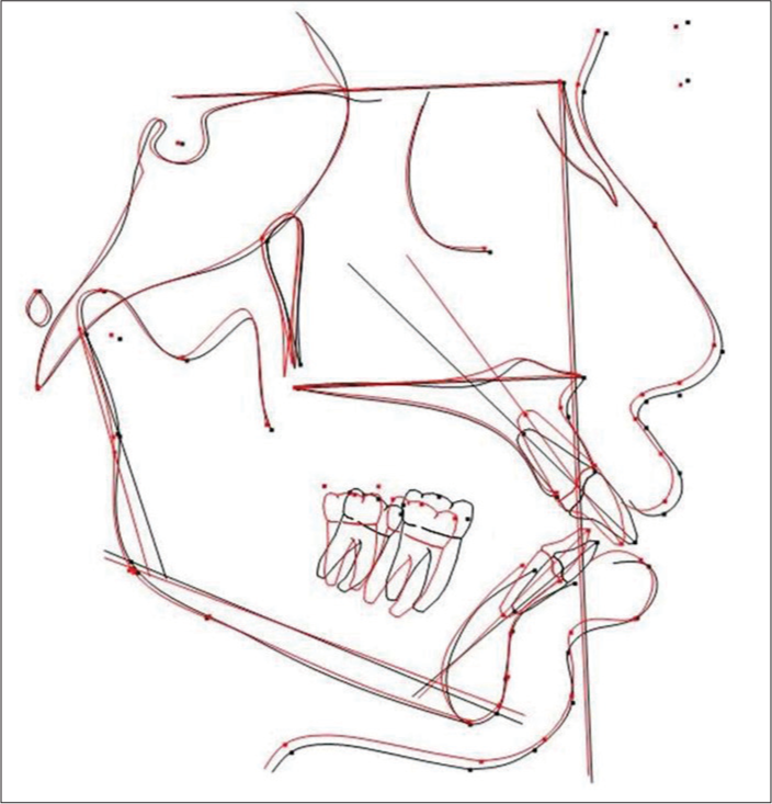 Superimposition of pre- and post-treatment lateral cephalogram (pretreatment: black and posttreatment red)