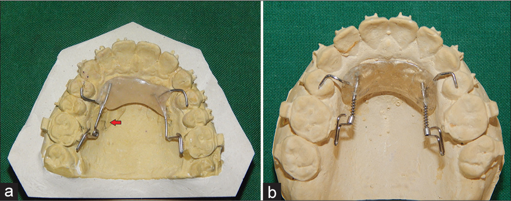 Smart distal-propeller appliance (a) unilateral distalization (b) bilateral distalization