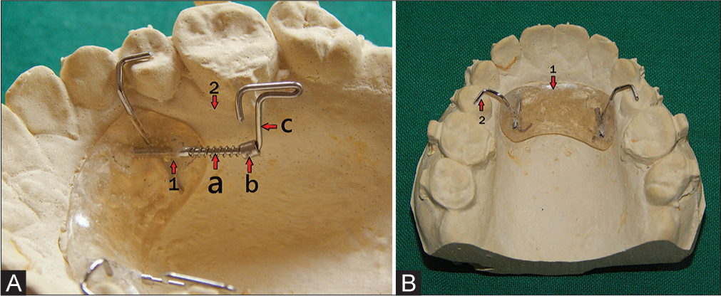 (A) Distalizing unit, (1) Hollow metallic tube, (2) Sliding component: (a) Horizontal arm. (b) Stopper. (c) Vertical arm. (B) Anchorage unit: (1) Modified Nance button. (2) Anchor arm