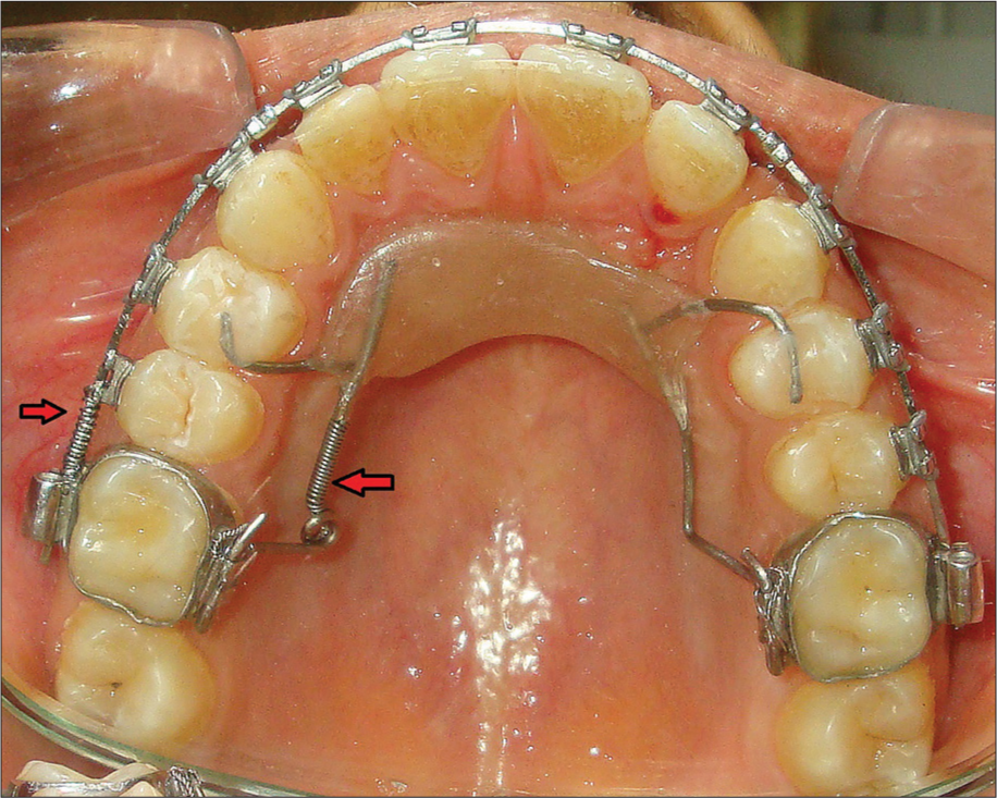 Intraoral smart distal-propeller appliance, with nickel-titanium coil spring in palatal and buccal region for unilateral maxillary first molar distalization