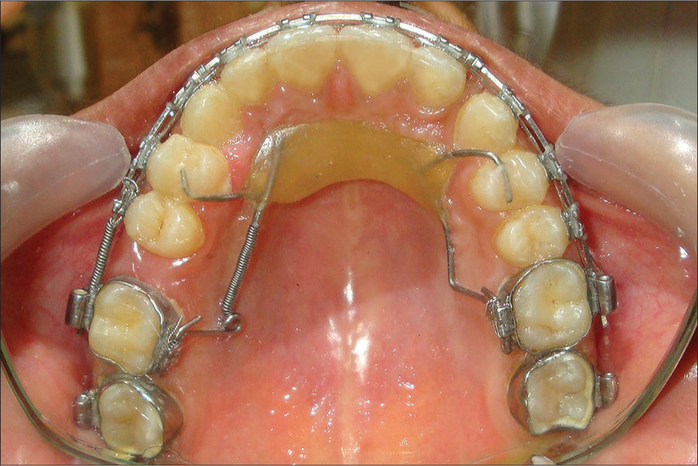 Five millimeter of molar distalization achieved in 9 weeks