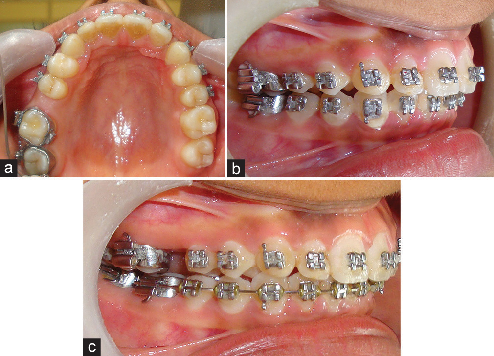 (a) Postdistalization shows minimal palatal tissue irritation after appliance removal. (b) Predistalization endon molar relation seen on the right lateral photograph. (c) Postdistalization Class I molar relation seen on the right lateral photograph