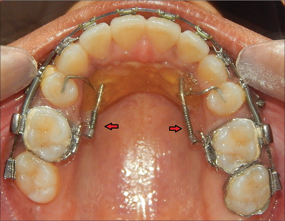 Smart distal-propeller appliance for bilateral molar distalization